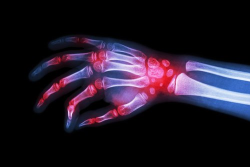 No Wrist Damage with Early JIA Treatment Targeting Inactive Disease, Trial Finds